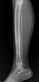 Chronic osteomyelitis (Radiopaedia 50192-55539 Lateral 1).png