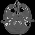 Chronic otomastoiditis (Radiopaedia 27138-27309 Axial bone window 3).jpg