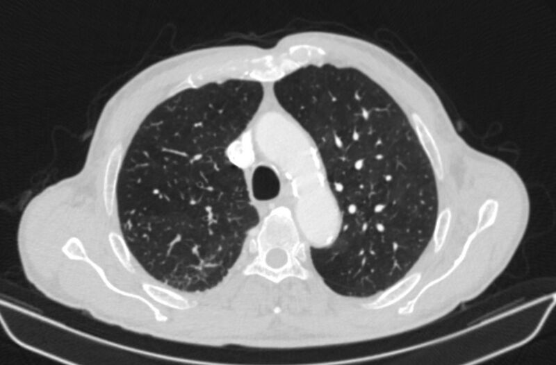 File:Chronic pulmonary embolism (Radiopaedia 91241-108843 Axial lung window 25).jpg