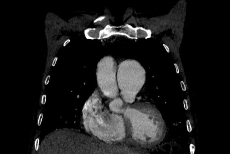 File:Chronic pulmonary embolism with bubbly consolidation (Radiopaedia 91248-108850 B 41).jpg