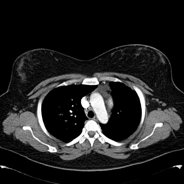 File:Chronic thromboembolic pulmonary hypertension (CTEPH) (Radiopaedia 74597-85531 Axial C+ CTPA 16).jpg