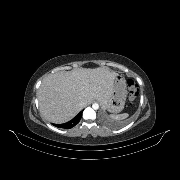 File:Chronic thromboembolic pulmonary hypertension (CTEPH) (Radiopaedia 74597-85532 Axial C+ CTPA 23).jpg