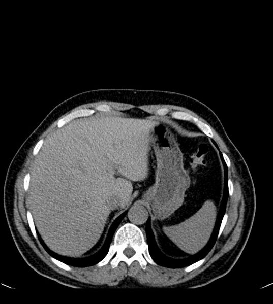 File:Clear cell renal cell carcinoma (Radiopaedia 85006-100539 Axial non-contrast 20).jpg