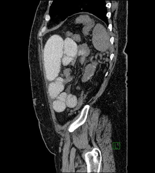 File:Closed-loop small bowel obstruction-internal hernia (Radiopaedia 78439-91096 C 36).jpg