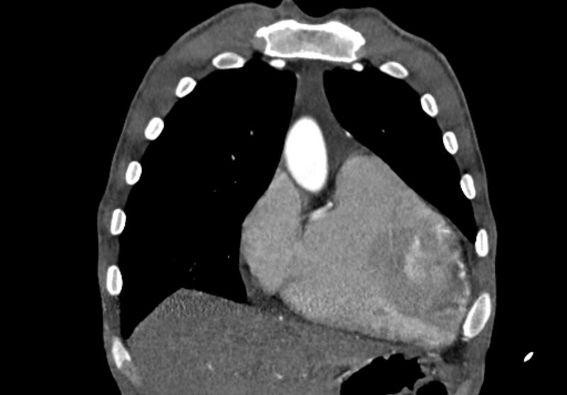 File:Coarctation of aorta with aortic valve stenosis (Radiopaedia 70463-80574 C 39).jpg