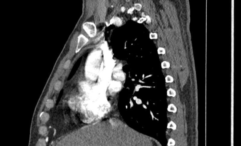 File:Coarctation of the aorta (Radiopaedia 53363-59343 B 19).jpg