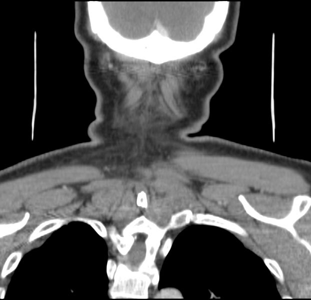 File:Colloid cyst of thyroid (Radiopaedia 22897-22923 Coronal C+ delayed 57).jpg
