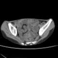 Colocolic fistula - Crohn disease (Radiopaedia 57063-63955 A 75).jpg