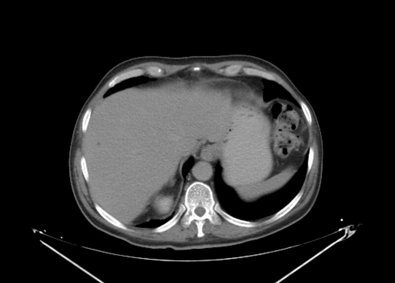 File:Colon cancer mimicking renal cell carcinoma (Radiopaedia 28986-29335 Axial C+ delayed 10).jpg