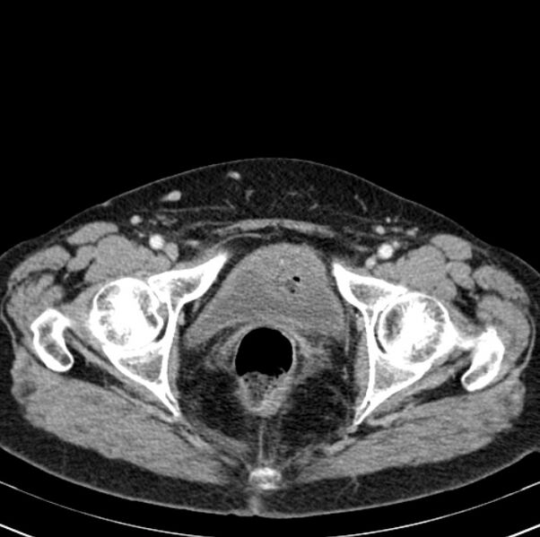 File:Colon carcinoma with hepatic metastases (Radiopaedia 29477-29961 A 110).jpg