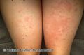 Contact dermatitis due to isocyanate (DermNet NZ contact-dermatitis-isocyanate-05).jpg