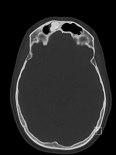 File:Frontal sinus osteoma (Radiopaedia 41657).jpg