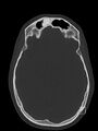 Frontal sinus osteoma (Radiopaedia 41657).jpg