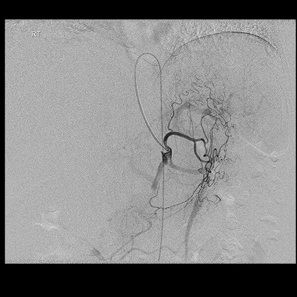 File:Left gastric artery (Radiopaedia 36177).jpg