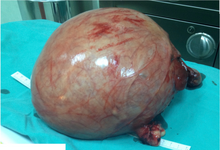 Leiomyoma. Removed uterus with large fibroid.