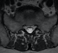 McFerrin syndrome (Rorschach radiology) (Radiopaedia 46839).png