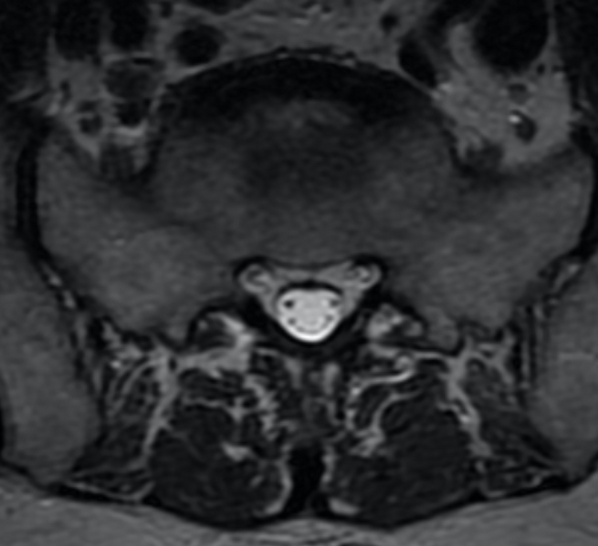 File:McFerrin syndrome (Rorschach radiology) (Radiopaedia 46839).png