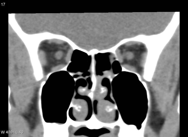 File:Nasolacrimal dacrocystocele (Radiopaedia 13814-13694 Coronal liver window 14).jpg