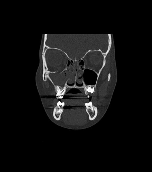 File:Nasoorbitoethmoid fracture (Radiopaedia 90044-107205 Coronal bone window 49).jpg