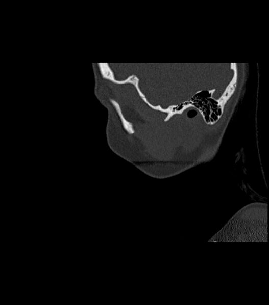 File:Nasoorbitoethmoid fracture (Radiopaedia 90044-107205 Sagittal bone window 124).jpg