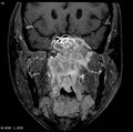 Nasopharyngeal carcinoma (Radiopaedia 4546-6667 E 5).jpg
