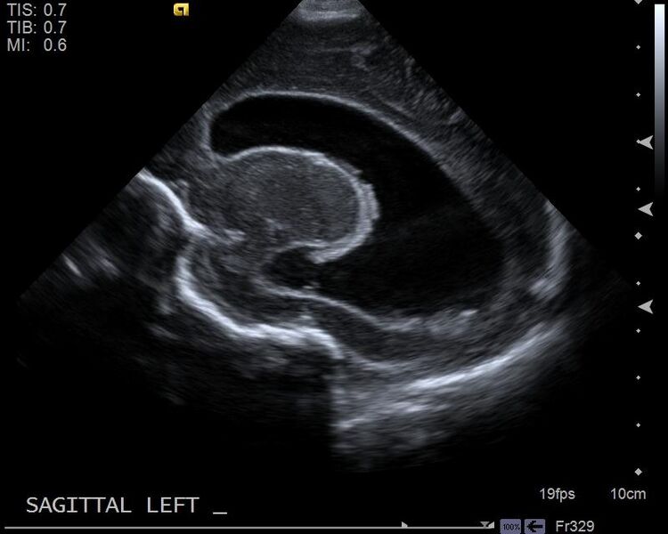 File:Neonatal intracranial hemorrhage - grade 3 (Radiopaedia 27279-27455 Longitudinal 14).jpg