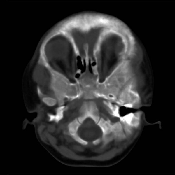 File:Neuroblastoma with skull metastases (Radiopaedia 30326-30958 Axial bone window 1).jpg