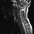 Neurofibromatosis type 1 (Radiopaedia 80355-93740 Sagittal T2 3).jpg
