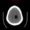 Neuroglial cyst (Radiopaedia 10713-11185 Axial non-contrast 8).jpg