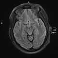 Neurotoxoplasmosis - concentric target sign (Radiopaedia 70644-80784 Axial FLAIR 9).jpg
