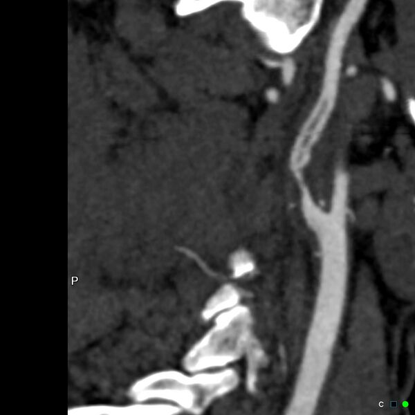 File:Non-occlusive intraluminal internal carotid artery thrombus (Radiopaedia 37751-39658 A 22).jpg