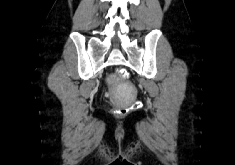 File:Non-puerperal uterine inversion (Radiopaedia 78343-91094 B 54).jpg
