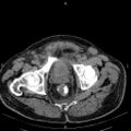 Non Hodgkin lymphoma in a patient with ankylosing spondylitis (Radiopaedia 84323-99621 Axial non-contrast 59).jpg