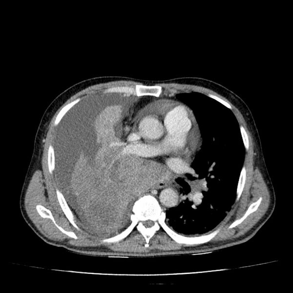 File:Non small-cell lung cancer (Radiopaedia 24467-24769 C+ delayed 31).jpg