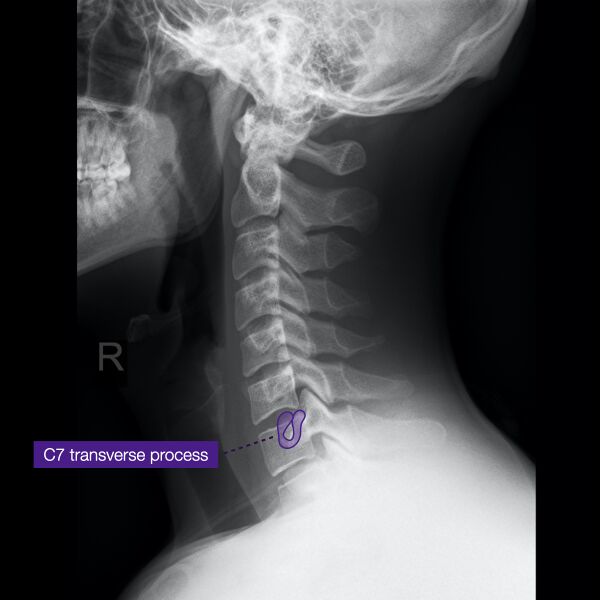 File:Normal cervical spine radiographs (Radiopaedia 32505-96697 A 13).jpeg