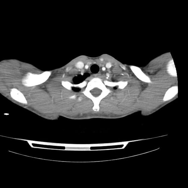 File:Normal dual-phase trauma CT chest,abdomen and pelvis (Radiopaedia 48092-52899 A 4).jpg