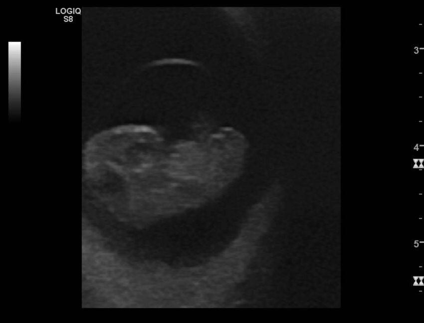 Normal early pregnancy - 8w0d (Radiopaedia 44715-48492 Longitudinal 31).jpg