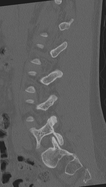 File:Normal lumbar spine CT (Radiopaedia 46533-50986 Sagittal bone window 65).png