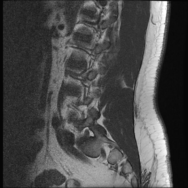File:Normal lumbar spine MRI (Radiopaedia 43051-46311 Sagittal T1 5).jpg