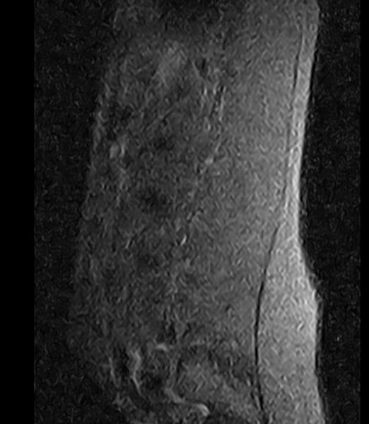 File:Normal lumbar spine MRI - low-field MRI scanner (Radiopaedia 40976-43699 Sagittal STIR 11).jpg