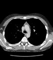 Normal thymus (Radiopaedia 39553-41859 A 1).jpg