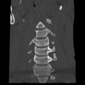 Normal trauma cervical spine (Radiopaedia 41017-43760 Coronal bone window 11).png