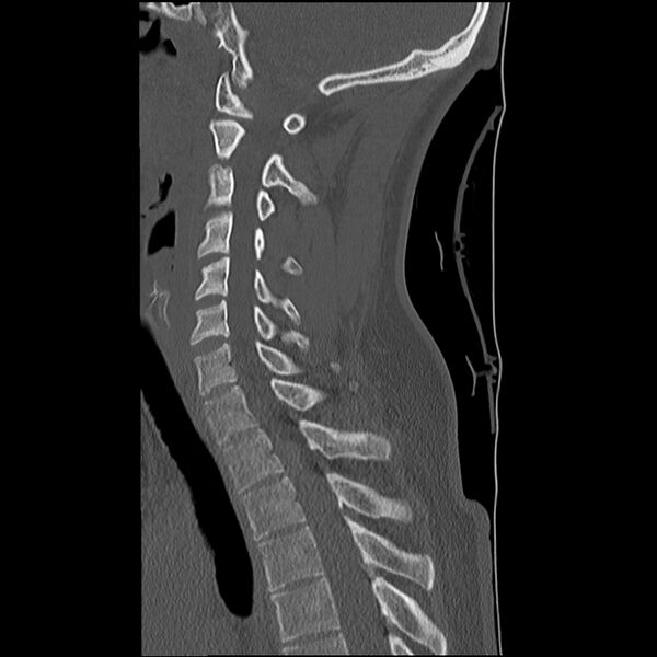 File:Normal trauma spine imaging (Radiopaedia 31753-32686 Sagittal bone window 24).jpg