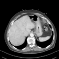 Nutmeg liver (Radiopaedia 49958-55246 A 12).png