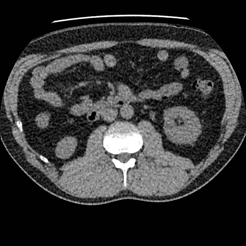 Obstructing ureteric calculus and ureteric anatomy (Radiopaedia 62730-71042 Axial non-contrast 53).jpg