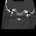 Occipital condyle fracture (Radiopaedia 18366-18208 Coronal bone window 3).jpg