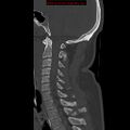 Occipital condyle fracture (Radiopaedia 18366-18208 Sagittal bone window 19).jpg