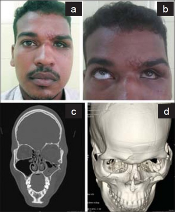 a)Enophthalmos and hypoglobus in left eye, b) restricted left eyeball movement in upward gaze, c) blow out fracture of left orbital floor d) fracture and outward displaced left orbital floor