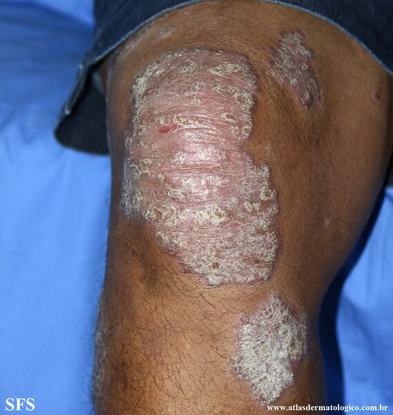 File:Psoriasis (Dermatology Atlas 152).jpg