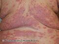 Severe psoriasis (DermNet NZ psoriasis-severe).jpg